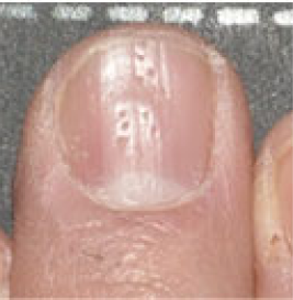 nail